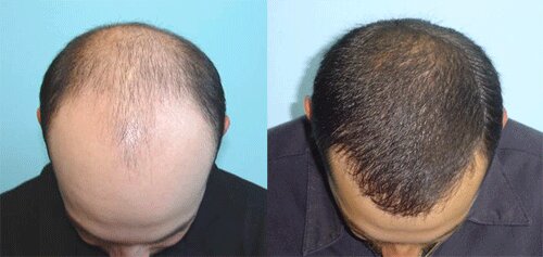 Hair Transplant